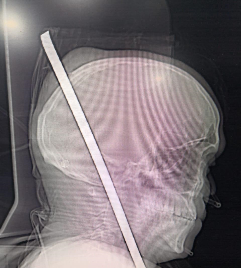 छातीत रॉड घुसून जबड्यावाटे कवटीतून बाहेर, गुंतागुंतीची शस्त्रक्रिया यशस्वी
